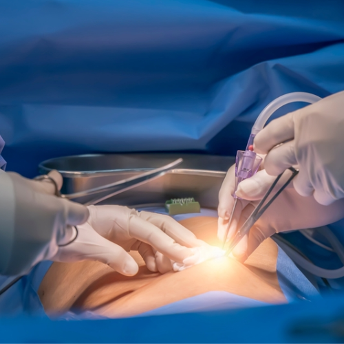 Laparoscopic Ectopic Pregnancy Removal in Chennai